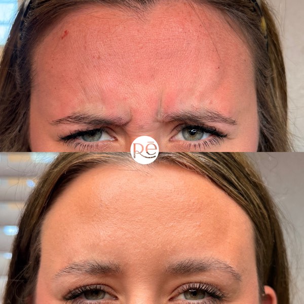 Botox and Dysport result 1 at ReViVe Aesthetics & Healthcare
