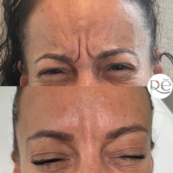Botox and Dysport result 2 at ReViVe Aesthetics & Healthcare