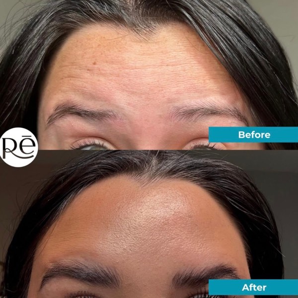 Botox and Dysport result 3 at ReViVe Aesthetics & Healthcare