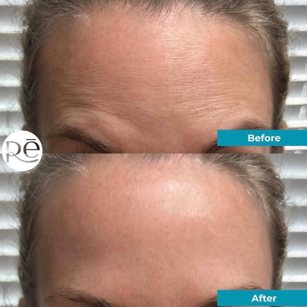 Botox and Dysport result 4 at ReViVe Aesthetics & Healthcare