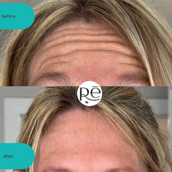 Botox and Dysport result 5 at ReViVe Aesthetics & Healthcare