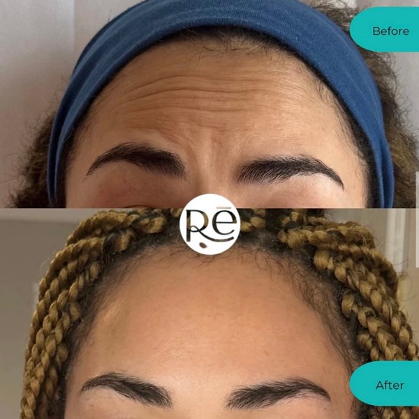 Botox and Dysport result 6 at ReViVe Aesthetics & Healthcare