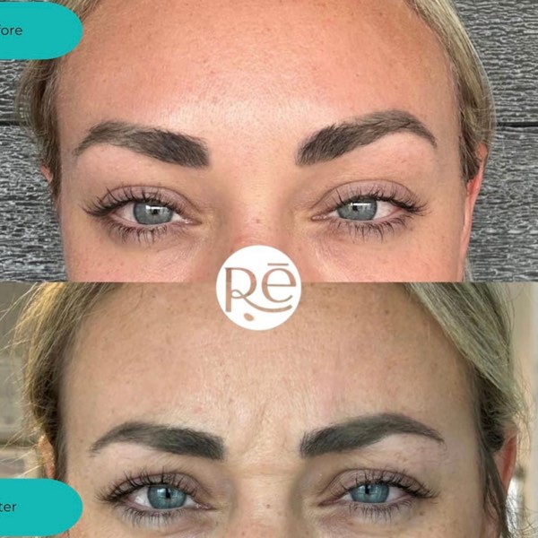 Botox and Dysport result 7 at ReViVe Aesthetics & Healthcare