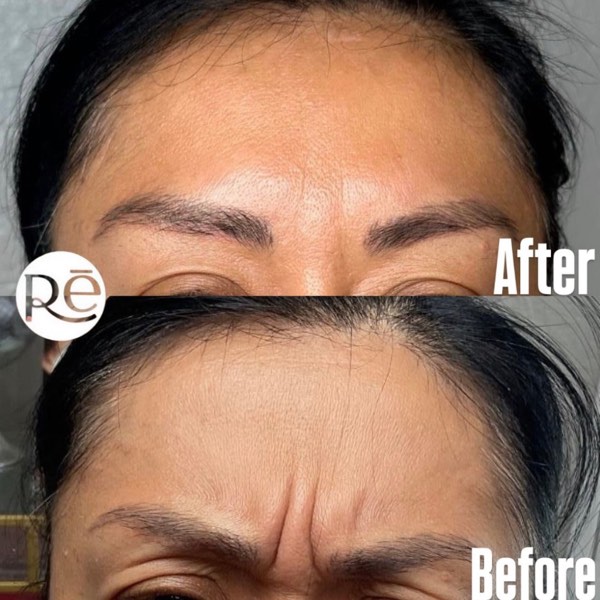 Botox and Dysport result 8 at ReViVe Aesthetics & Healthcare