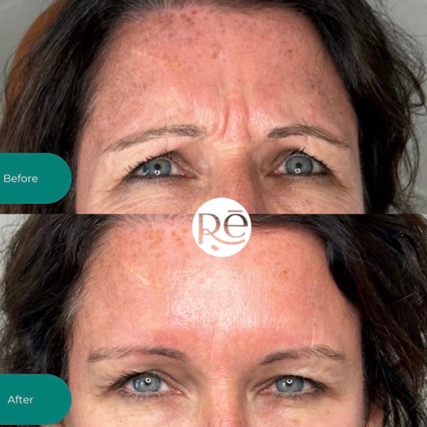 Botox and Dysport result 9 at ReViVe Aesthetics & Healthcare