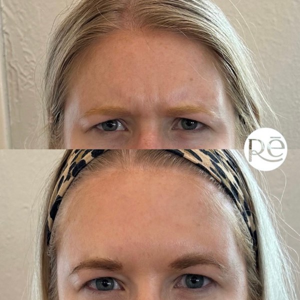 Botox and Dysport result 10 at ReViVe Aesthetics & Healthcare