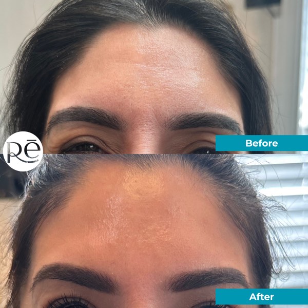 Botox and Dysport result 11 at ReViVe Aesthetics & Healthcare
