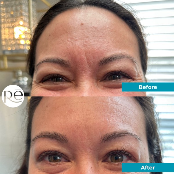 Botox and Dysport result 12 at ReViVe Aesthetics & Healthcare