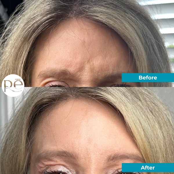 Botox and Dysport result 13 at ReViVe Aesthetics & Healthcare