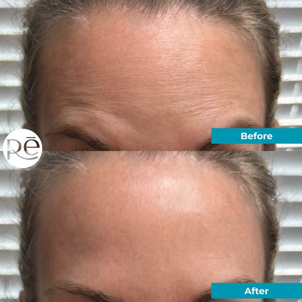 Botox and Dysport result 14 at ReViVe Aesthetics & Healthcare