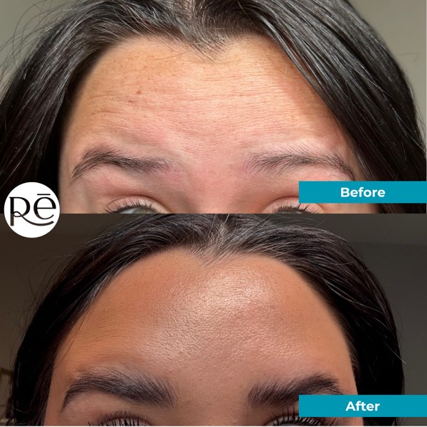 Botox and Dysport result 15 at ReViVe Aesthetics & Healthcare