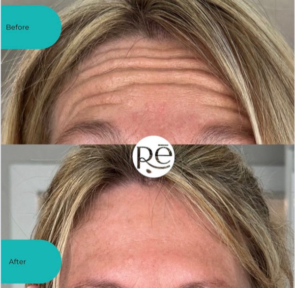 Botox and Dysport result 16 at ReViVe Aesthetics & Healthcare