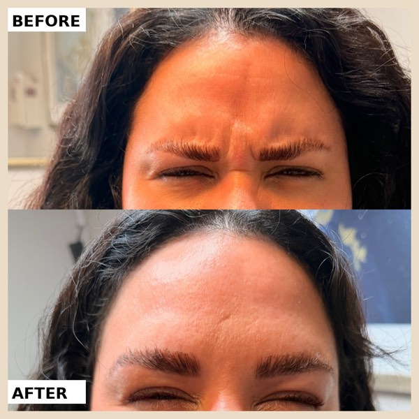 Botox and Dysport result 17 at ReViVe Aesthetics & Healthcare