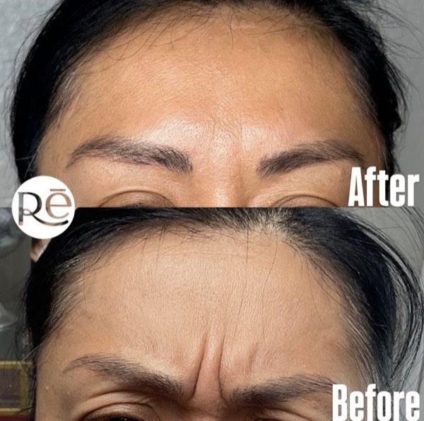 Botox and Dysport result 18 at ReViVe Aesthetics & Healthcare