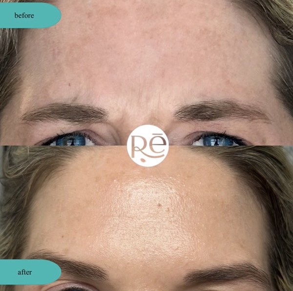 Botox and Dysport result 19 at ReViVe Aesthetics & Healthcare