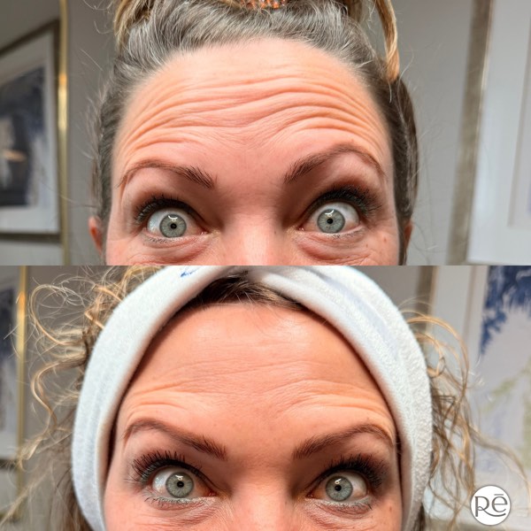 Botox and Dysport result 20 at ReViVe Aesthetics & Healthcare