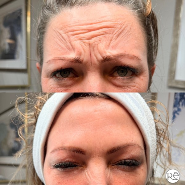 Botox and Dysport result 21 at ReViVe Aesthetics & Healthcare
