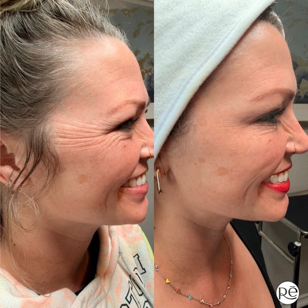 Botox and Dysport result 22 at ReViVe Aesthetics & Healthcare