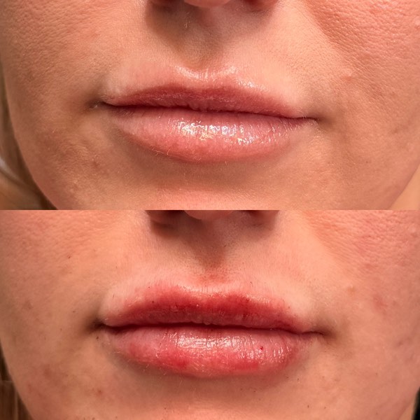 Dermal and lip filler result 1 at ReViVe Aesthetics & Healthcare