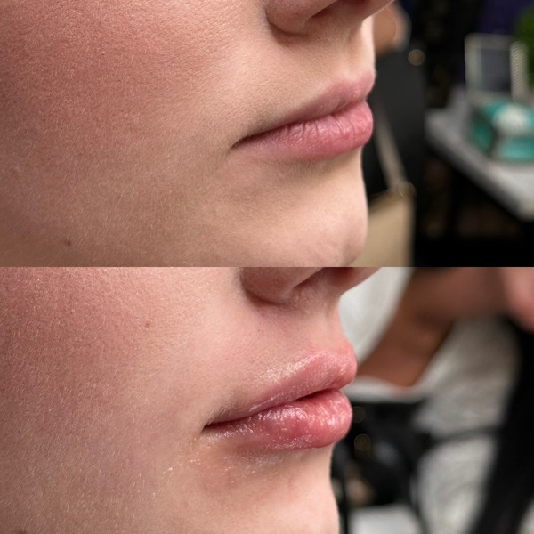 Dermal and lip filler result 2 at ReViVe Aesthetics & Healthcare
