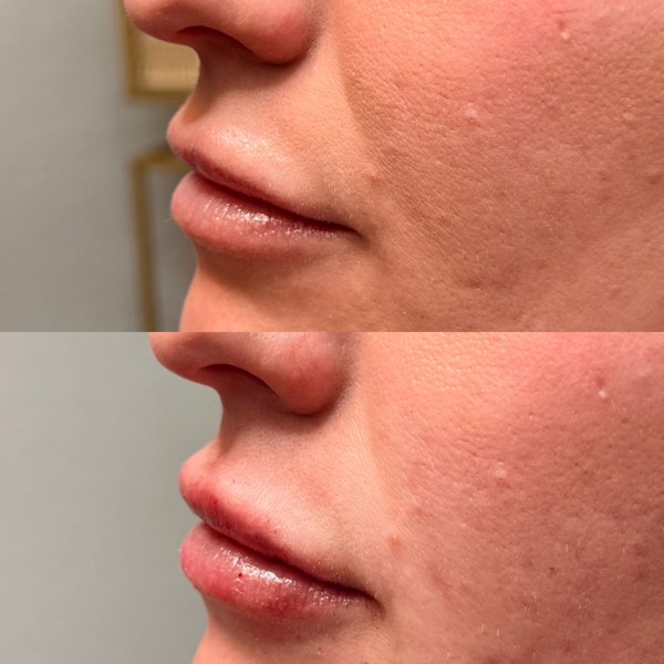 Dermal and lip filler result 3 at ReViVe Aesthetics & Healthcare