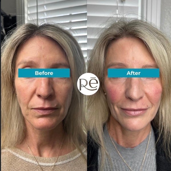 Dermal and lip filler result 4 at ReViVe Aesthetics & Healthcare