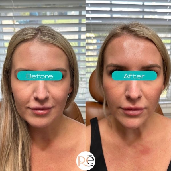 Dermal and lip filler result 5 at ReViVe Aesthetics & Healthcare