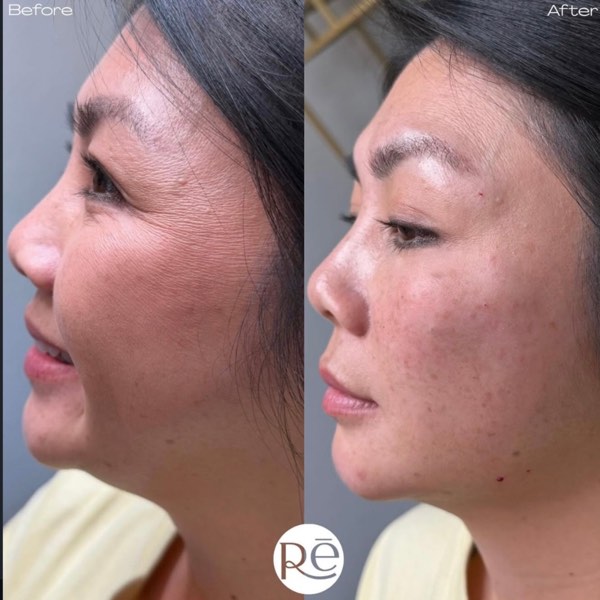 Dermal and lip filler result 6 at ReViVe Aesthetics & Healthcare
