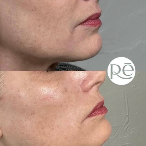 Dermal and lip filler result 7 at ReViVe Aesthetics & Healthcare