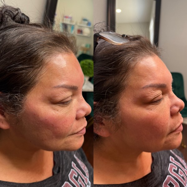 Dermal and lip filler result 8 at ReViVe Aesthetics & Healthcare
