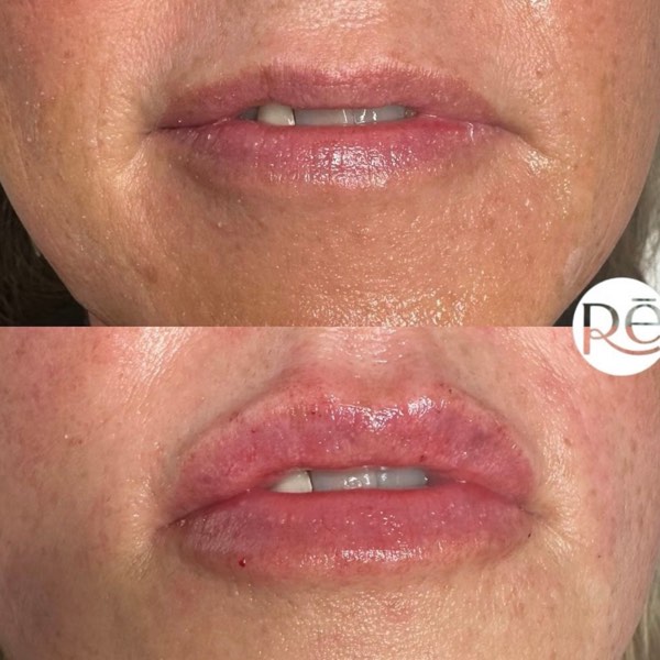 Dermal and lip filler result 9 at ReViVe Aesthetics & Healthcare