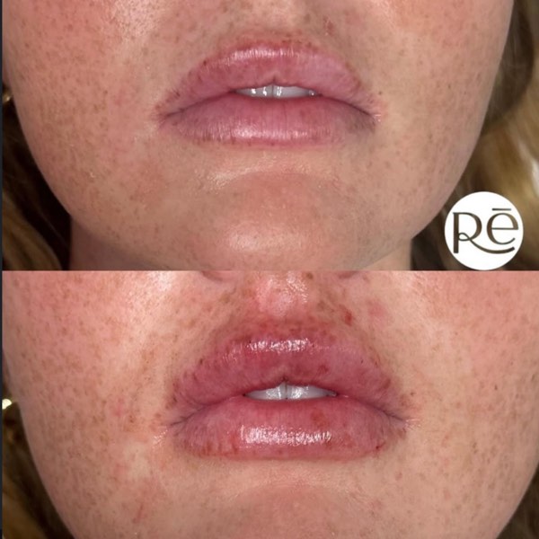 Dermal and lip filler result 10 at ReViVe Aesthetics & Healthcare