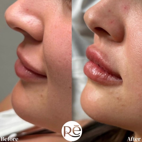 Dermal and lip filler result 11 at ReViVe Aesthetics & Healthcare