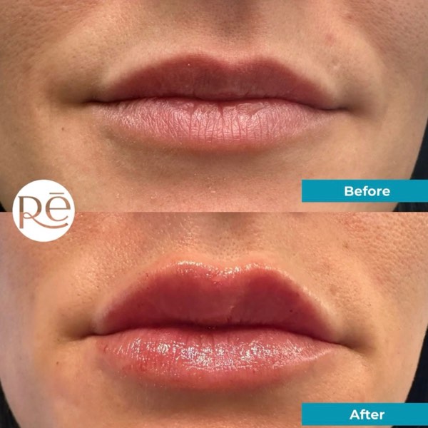 Dermal and lip filler result 12 at ReViVe Aesthetics & Healthcare