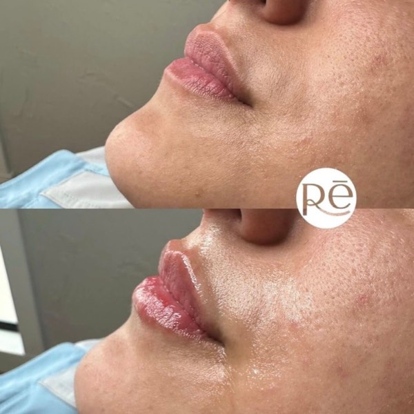 Dermal and lip filler result 13 at ReViVe Aesthetics & Healthcare