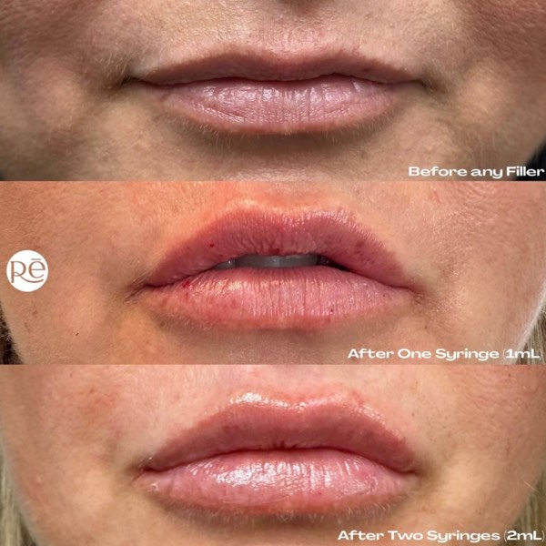 Dermal and lip filler result 14 at ReViVe Aesthetics & Healthcare