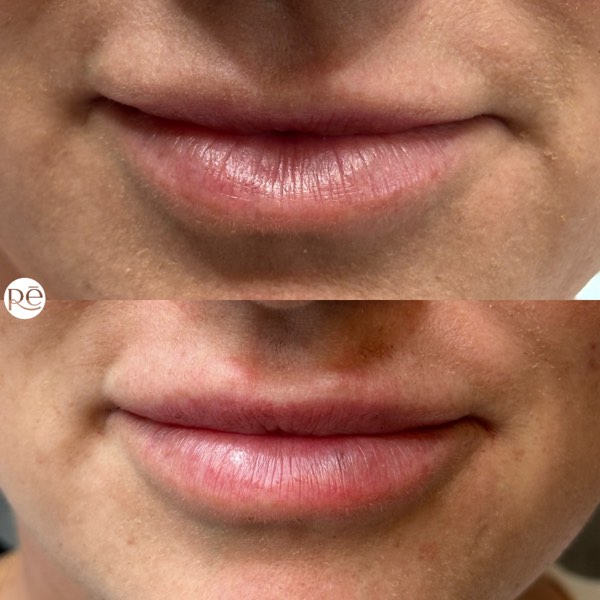 Dermal and lip filler result 16 at ReViVe Aesthetics & Healthcare