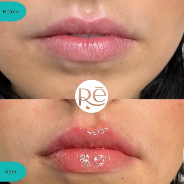 Dermal and lip filler result 17 at ReViVe Aesthetics & Healthcare