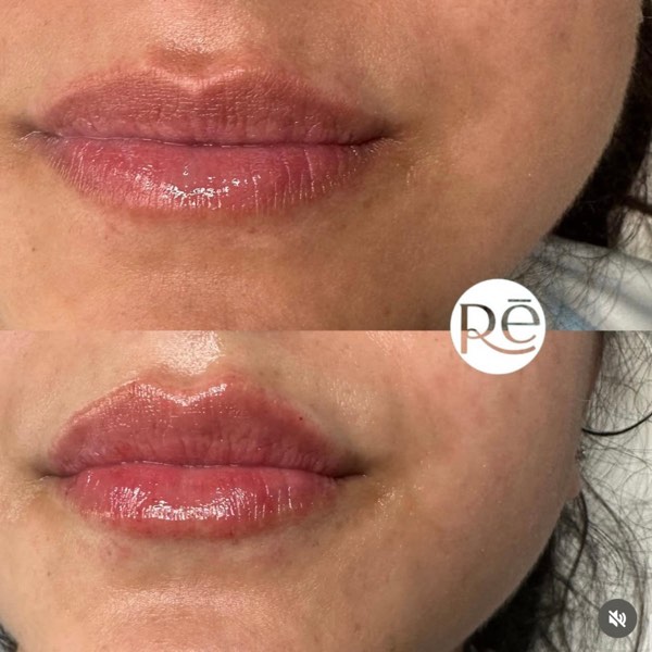 Dermal and lip filler result 18 at ReViVe Aesthetics & Healthcare