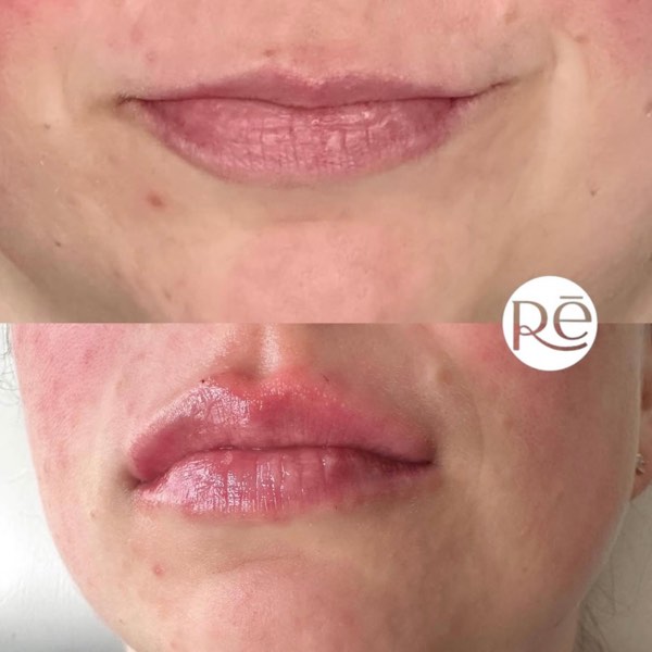 Dermal and lip filler result 19 at ReViVe Aesthetics & Healthcare