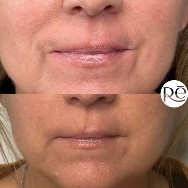 Dermal and lip filler result 20 at ReViVe Aesthetics & Healthcare