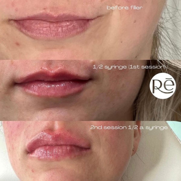 Dermal and lip filler result 21 at ReViVe Aesthetics & Healthcare