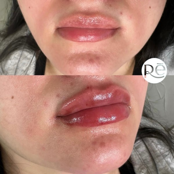 Dermal and lip filler result 22 at ReViVe Aesthetics & Healthcare