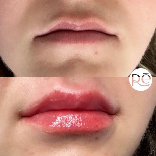 Dermal and lip filler result 23 at ReViVe Aesthetics & Healthcare
