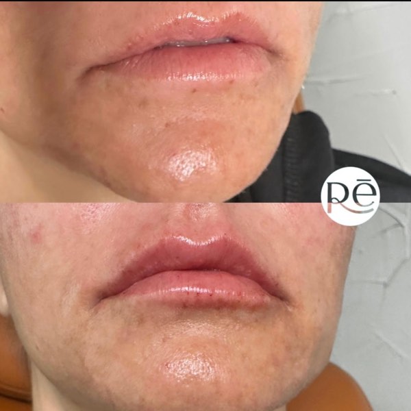Dermal and lip filler result 24 at ReViVe Aesthetics & Healthcare