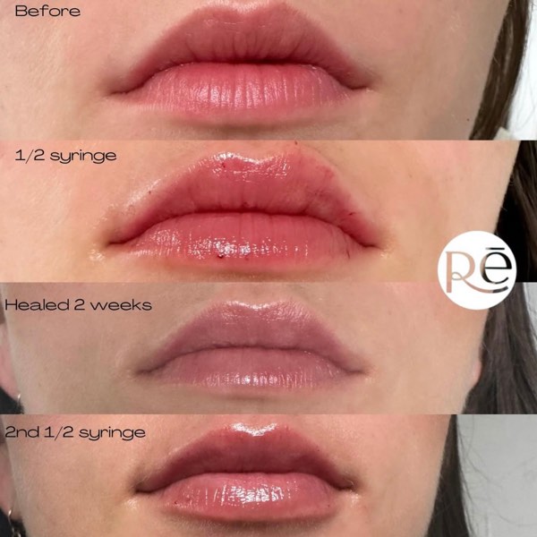Dermal and lip filler result 25 at ReViVe Aesthetics & Healthcare