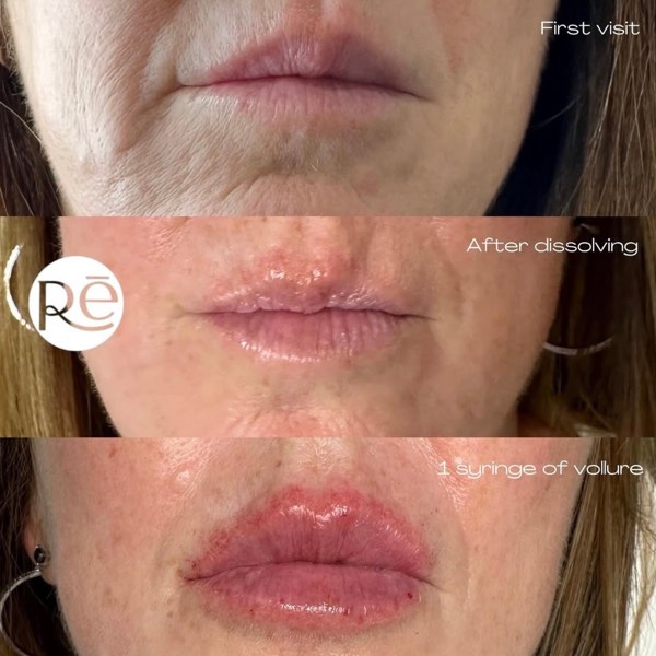 Dermal and lip filler result 26 at ReViVe Aesthetics & Healthcare