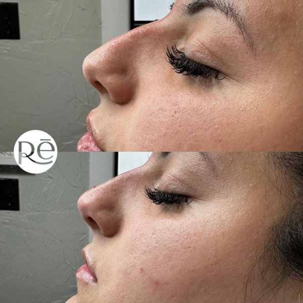 Dermal and lip filler result 27 at ReViVe Aesthetics & Healthcare