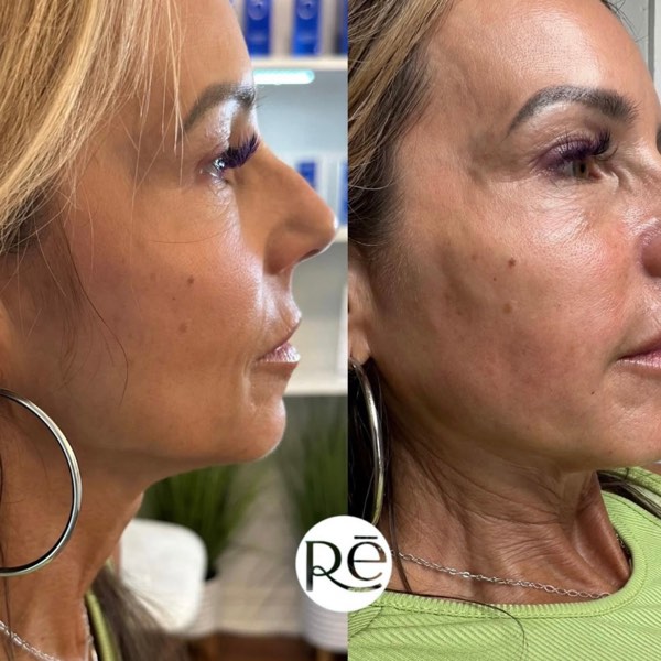 Dermal and lip filler result 28 at ReViVe Aesthetics & Healthcare