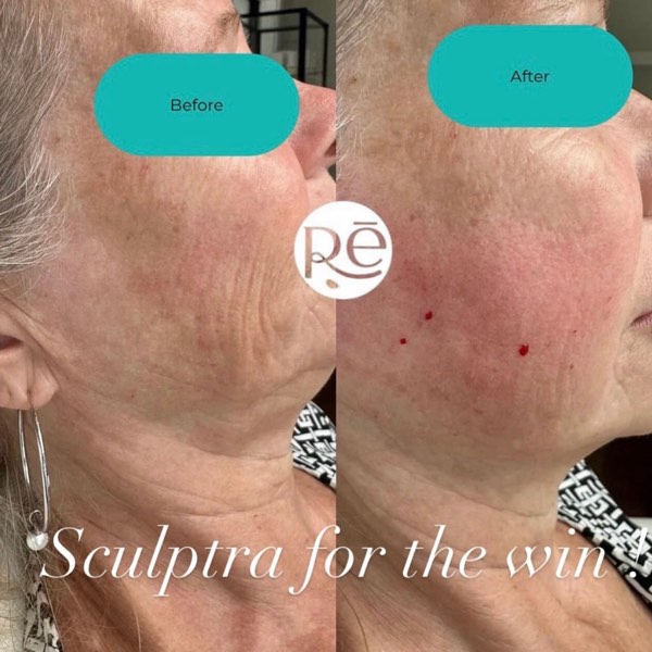 Dermal and lip filler result 29 at ReViVe Aesthetics & Healthcare